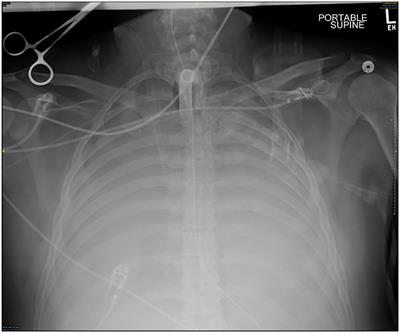 Massive hemoptysis bridged with VV ECMO: A case report